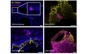 癌細胞會放電？Nature揭示小細胞肺癌擴散新機制