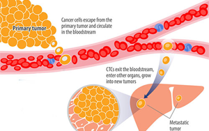 Nature Medicine一項開創(chuàng)性的新研究可防止乳腺癌復(fù)發(fā)