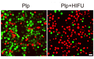 HIFU驅動靶向細胞焦亡治療基底樣乳腺癌：從基因篩選到血小板膜雜交脂質體的協(xié)同機制探索