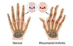 中性粒細胞與白蛋白比率（NPAR）：類風濕關節(jié)炎骨質疏松風險的新型預測因子及其臨床轉化價值