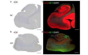 阿爾茨海默病中突觸囊泡蛋白2A在腦組織及胞外囊泡中的減少及其與Aβ、tau和APOEε4的關聯研究