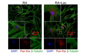 組蛋白乳酸化修飾通過上調(diào)NFATc2表達及抗乳酸化組蛋白自身抗體促進類風濕關(guān)節(jié)炎進展
